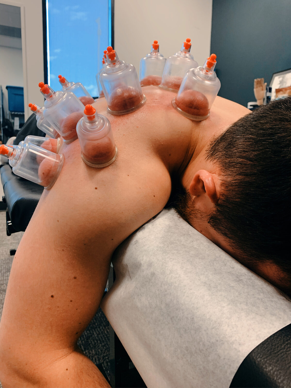 Cupping therapy for sports rehabilitation in Marietta, GA